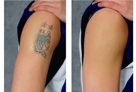 Tattoo removal spray call +256777422022